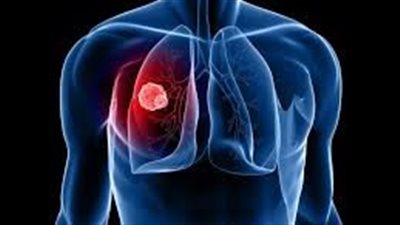 بعد الإعلان عن إصابة وزير التموين السابق بسرطان الرئة.. متى يجب القلق؟