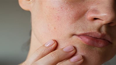 التخلص من حب الشباب.. نصائح وأساليب فعالة في مواجهة تقلبات الجو