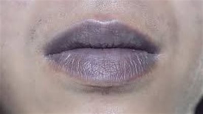 سواد الشفاه.. الأسباب الشائعة وطرق فعالة للعلاج واستعادة اللون الطبيعي