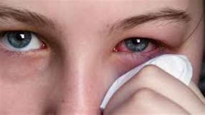 الصحة تحذر من 5 أعراض للإصابة بمرض الرمد الربيعي وكيفية الوقاية منه