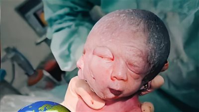 صدفة غريبة..ولادة توأم أحدهما بوجهين تُثير مشاعر الطاقم الطبي في أربيل