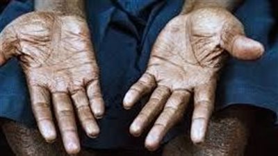 الصحة توضح: الجذام لا يُعدي بسهولة والعلاج مجاني بالكامل