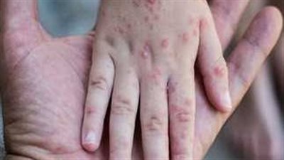 استشاري مناعة يوضح الفرق بين الجدري والجدري المائي وخطورة الإصابة عند الكبار