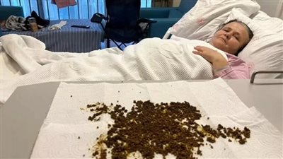 استخراج عشرين ألف حصوة من مريضة تركية في حالة طبية نادرة مذهلة