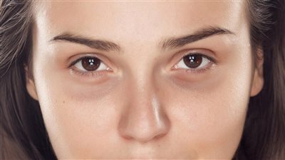وصفات طبيعية لتقليل الهالات السوداء بسبب السهر.. حلول بسيطة لاستعادة نضارة العين
