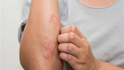 روشتة سحرية لعلاج تقرحات الجلد.. تعرفي عليها