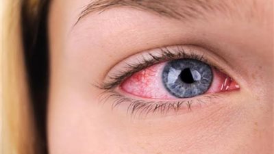 «من المطبخ».. روشتة سحرية لعلاج جفاف العين