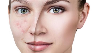 خلى بالك.. هذه الأطعمة تسبب انتشار «حب الشباب»